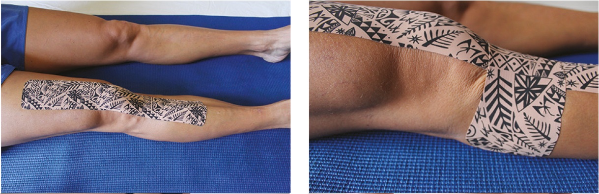 大腿四頭筋メカニズムテクニック