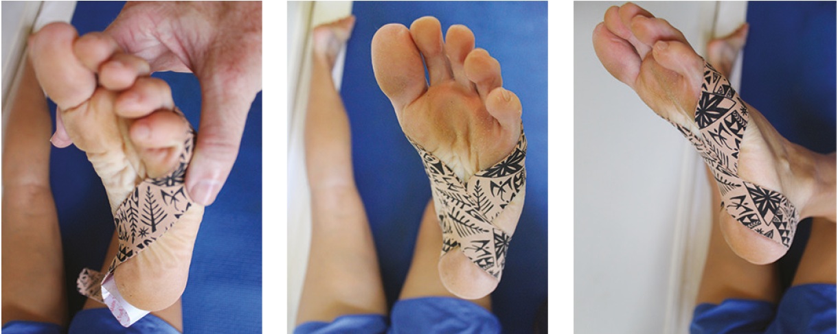 シンプルなアーチサポートテクニック